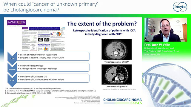 When could “cancer of unknown primary” be cholangiocarcinoma? Thumbnail