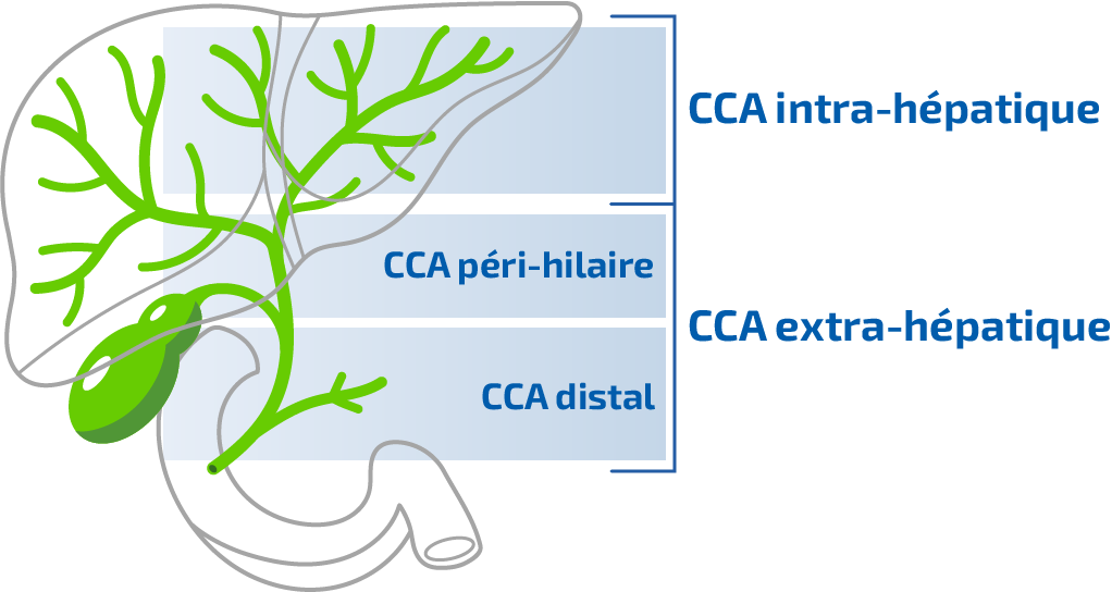 Quels sont les différents types de CCA ?